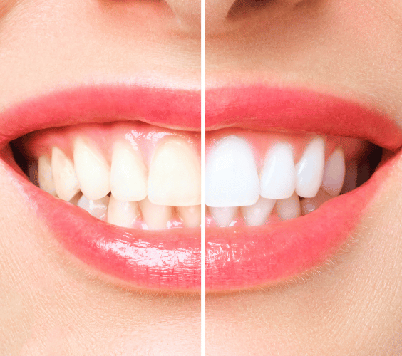 blanqueamiento-dental2 antes y después blanqueamiento dental
