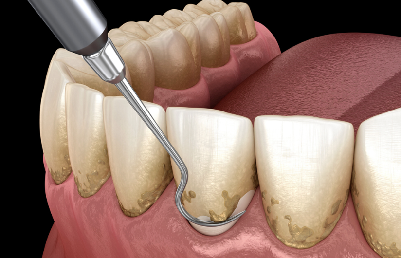periodoncia en valencia