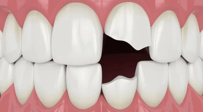 paciente revisando un diente roto en clínica dental